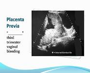 Obstetrical emergencies PowerPoint Presentation
