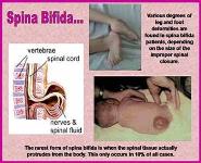 BIRTH DEFECTS PowerPoint Presentation