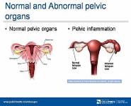 Pelvic Inflammatory Disease PowerPoint Presentation