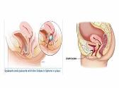 Utero-Vaginal Prolapse