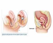 Utero-Vaginal Prolapse PowerPoint Presentation