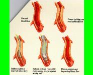 Antianginal Drugs PowerPoint Presentation
