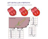 Antihypertensive Drugs PowerPoint Presentation