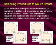Diagnosis Coding For Staged Breast Reconstruction Encounters PowerPoint Presentation