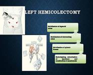 Laparoscopic colorectal surgery PowerPoint Presentation