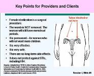 Characteristics of Tubal Ligation PowerPoint Presentation