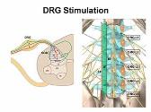 Spinal Cord and DRG Stimulation