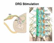 Spinal Cord and DRG Stimulation PowerPoint Presentation