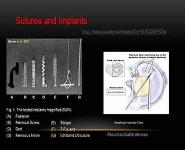 Meniscal Repair PowerPoint Presentation