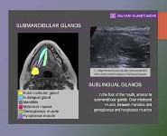 Radiodiagnosis of Salivary gland tumours PowerPoint Presentation