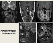 Radiological Imaging of Neck Schwannoma PowerPoint Presentation