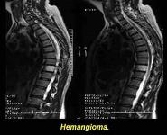 Radiological imaging of spinal cord tumour PowerPoint Presentation
