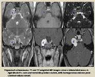 Radiological imaging of trigeminal schwannoma PowerPoint Presentation