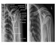 UPPER LIMB RADIOLOGY PowerPoint Presentation