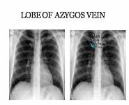 THORAX RADIOLOGY PowerPoint Presentation