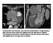 Imaging of Aortic Pathologies PowerPoint Presentation