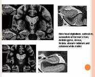 IMAGING IN MEDIAL TEMPORAL EPILEPSY PowerPoint Presentation