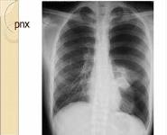 Imaging the chest in trauma PowerPoint Presentation
