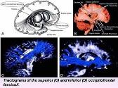 Diffusion tensor imaging of white matter tracts in patients with cerebral neoplasm