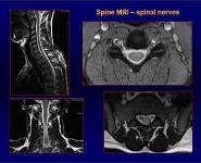 MR IMAGING OF SPINE PowerPoint Presentation