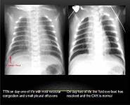 PAEDIATRIC CHEST IMAGING PowerPoint Presentation