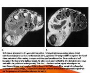 Imaging Findings in Musculoskeletal Complications of AIDS PowerPoint Presentation