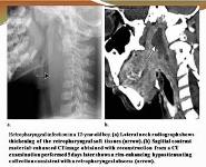 Imaging Acute Airway Obstruction in Infants and Children PowerPoint Presentation