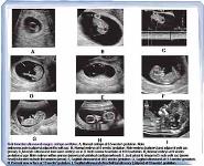 Overview of Obstetric Imaging and The First Trimester PowerPoint Presentation