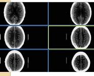 Brain Imaging in Trauma PowerPoint Presentation