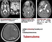Clinical radiology of cerebral tuberculosis PowerPoint Presentation