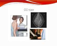 IMAGING IN BREAST CANCER PowerPoint Presentation