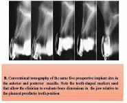 DIAGNOSTIC IMAGING AND TECHNIQUES FOR IMPLANT PATIENTS PowerPoint Presentation