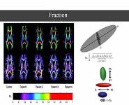 Diffusion tensor image in neurology PowerPoint Presentation