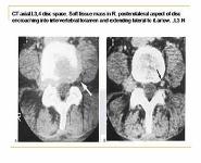 Disc prolapse and degenerative changes PowerPoint Presentation