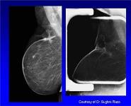 Imaging after Breast Cancer PowerPoint Presentation