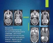 HEMANGIOBLASTOMA PowerPoint Presentation
