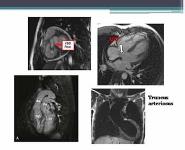 Cardiac MRI PowerPoint Presentation