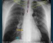 Basic Chest Radiology for the TB Clinician PowerPoint Presentation