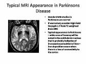 Rehabilitation Management of Parkinsons Disease