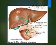 Cholestasis PowerPoint Presentation Notes