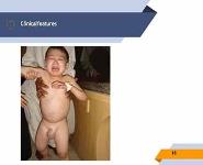 Nephrotic Syndrome in Pediatrics PowerPoint Presentation