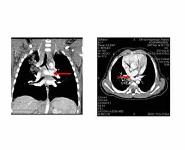 Acute severe asthma in children PowerPoint Presentation