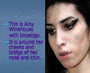 Impetigo PowerPoint Presentation