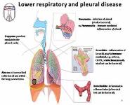 Pneumonia: Pathophysiology and Clinical Manifestations PowerPoint Presentation