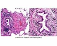 COPD-Epidemiology Pathogenesis and Pathophysiology PowerPoint Presentation