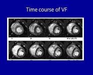 In-hospital Cardiac Arrest-First and foremost Chest Compressions PowerPoint Presentation