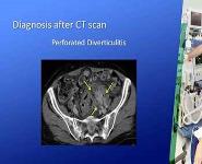 Case of Perforated Diverticulitis PowerPoint Presentation