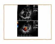 Eisenmenger Syndrome PowerPoint Presentation Notes