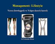 Osteoarthritis Knee PowerPoint Presentation