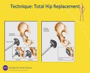 Arthritis of the Hip PowerPoint Presentation